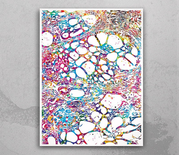 Nodular Basal Cell Carcinoma Watercolor Print Skin Histology Epidermis Dermatology Pathology Medical Art Integumentary Art Clinic Decor-2343