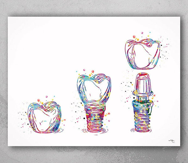Dental Implant Art Watercolor Print Tooth Anatomical Dental Clinic Decor Dentistry Student Science Graduaiton Dentist Gift Doctor Art-563