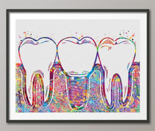 Dental Implant Art Watercolor Print Tooth Anatomical Dental Clinic Decor Dentistry Student Science Graduaiton Dentist Gift Doctor Art-238 - CocoMilla