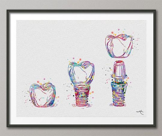 Dental Implant Art Watercolor Print Tooth Anatomical Dental Clinic Decor Dentistry Student Science Graduaiton Dentist Gift Doctor Art-563 - CocoMilla