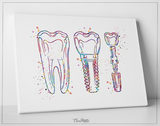 Implant Line Art Watercolor Print Tooth Office Art Dental implant Clinic Decor Dentistry Student Science Graduaiton Dentist Gift Doctor-1253 - CocoMilla